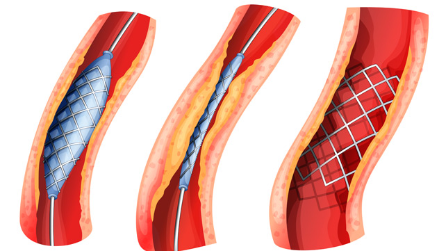 angioplasty doctor in ghaziabad
